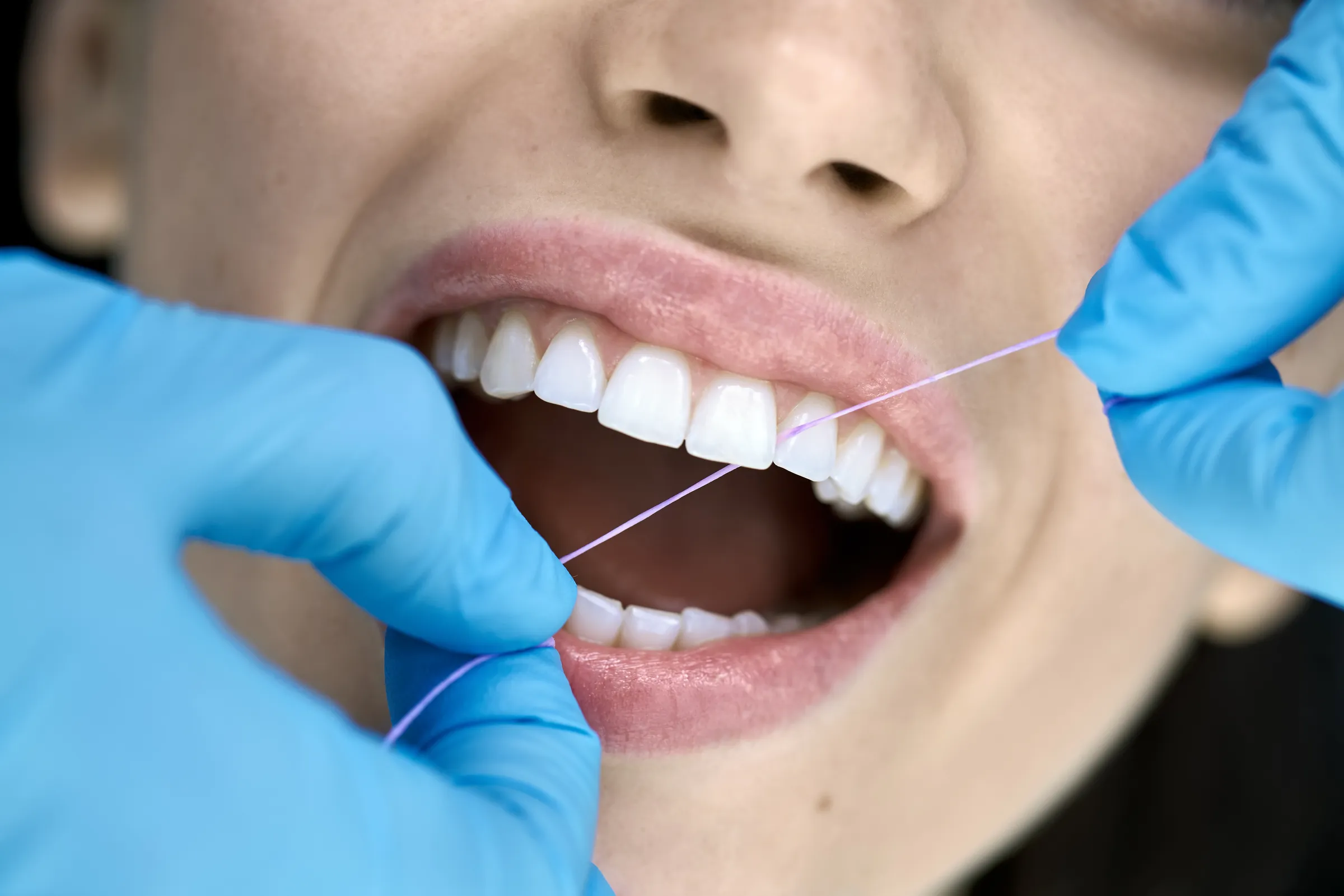 Professional dental cleaning