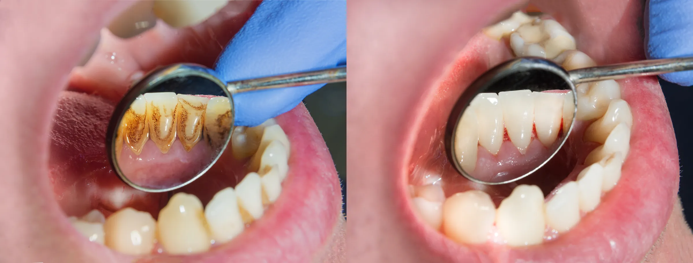Scaling and root planing procedure