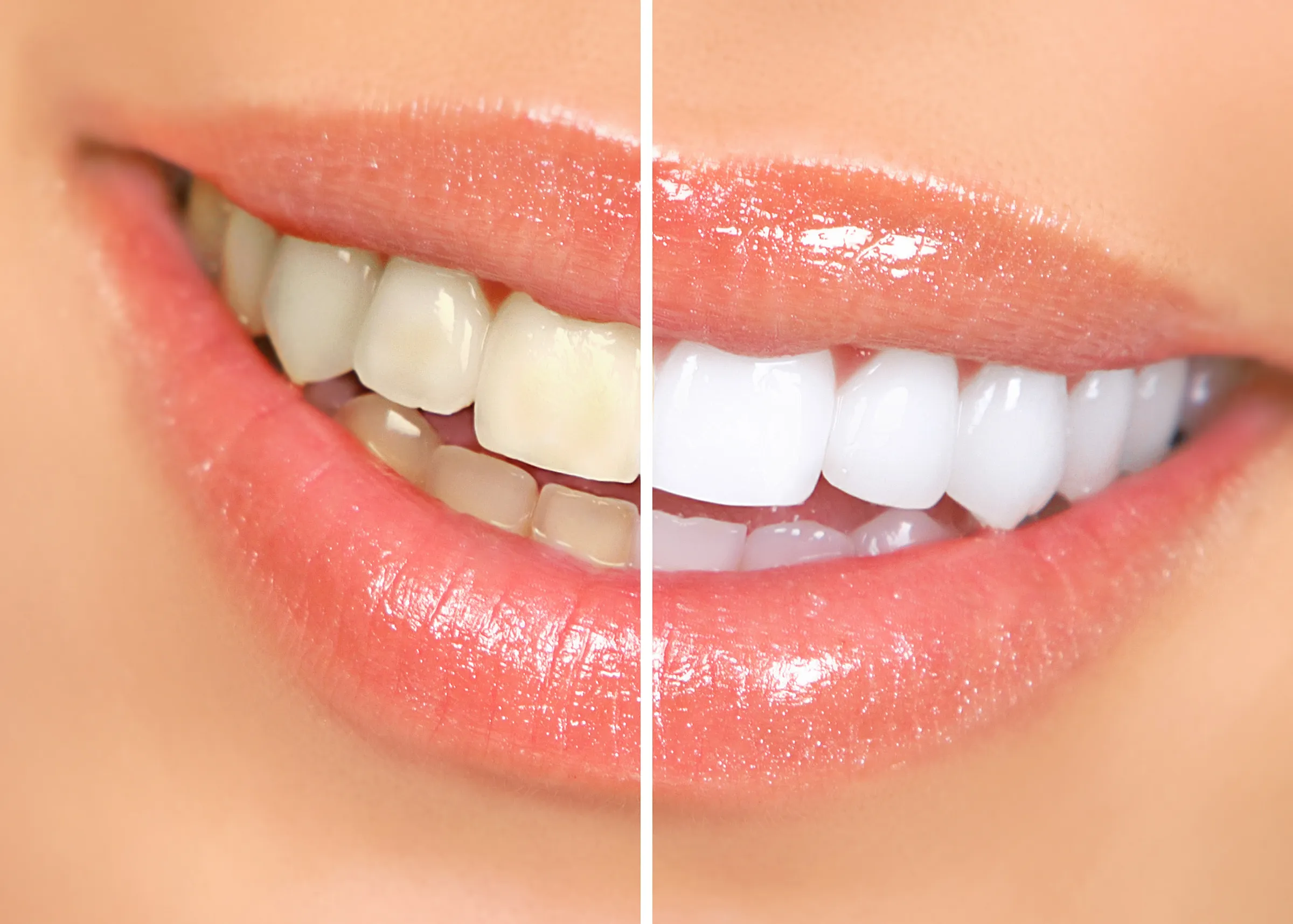 Smile makeover before and after