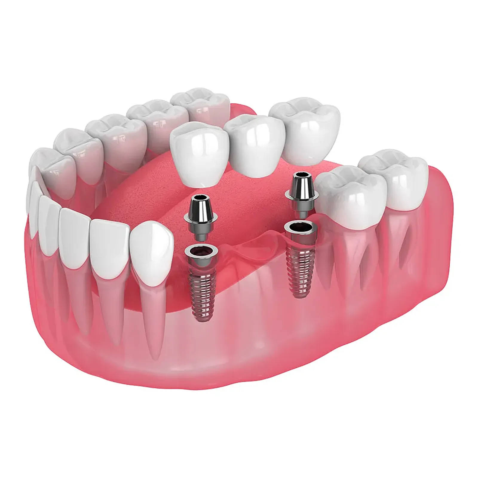 Ceramic dental bridge