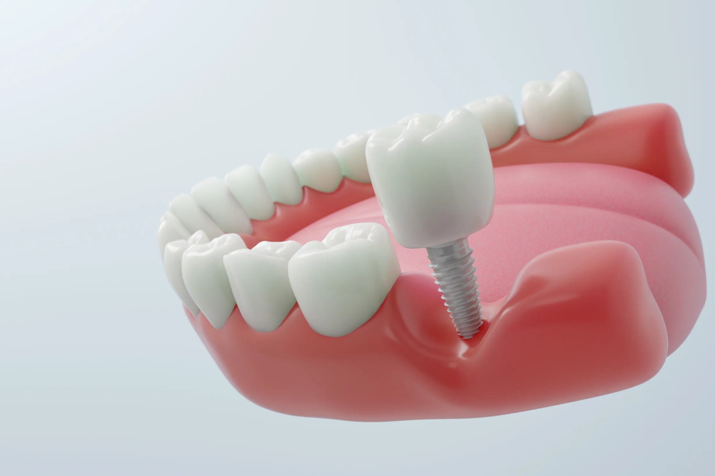 Ceramic dental implant replacing a single tooth in Sarasota, FL