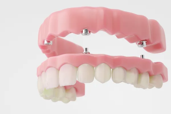Full dentures