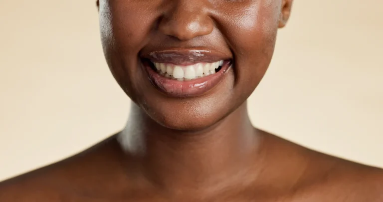 Gum Depigmentation