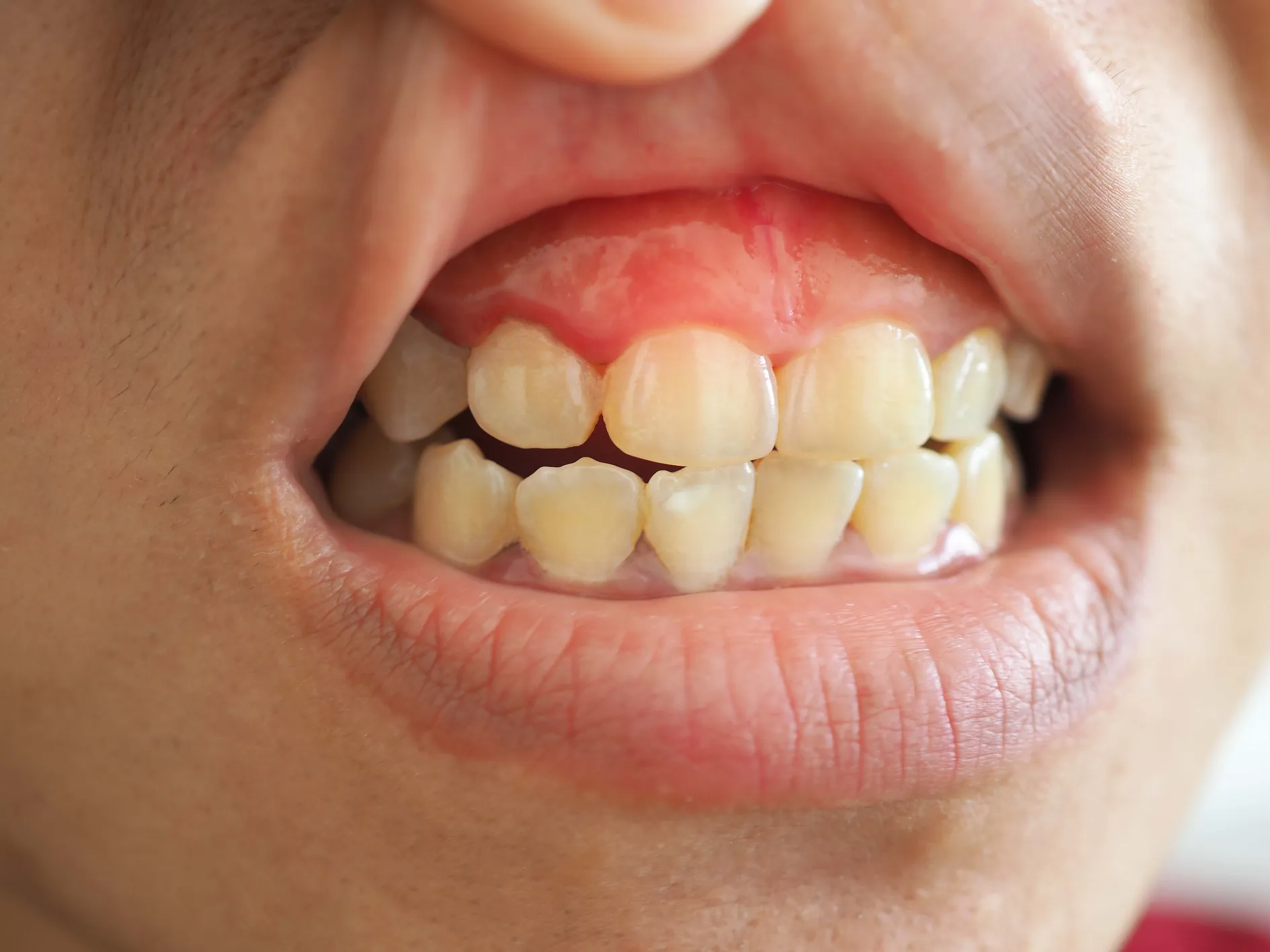 Gum contouring procedure