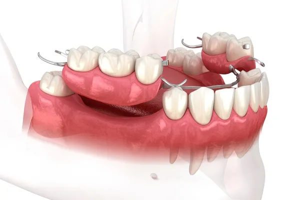 Partial dentures